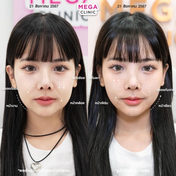 รีวิว Ultraformer ||| ยกกระชับหน้า เมกะคลินิก