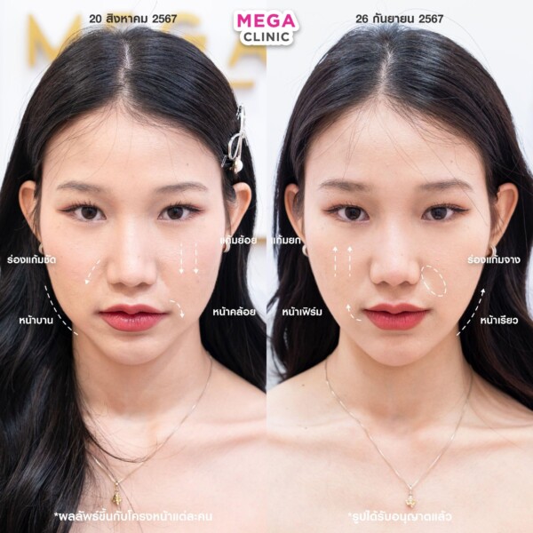 รีวิว Ultraformer ยกกระชับหน้า เมกะคลินิก