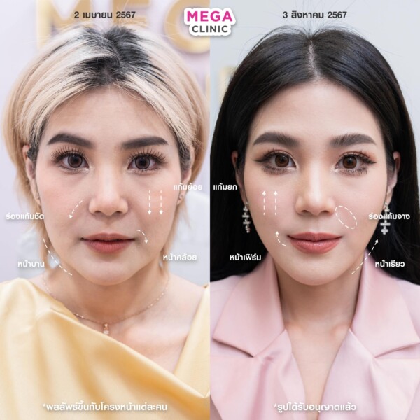 รีวิว Ultraformer ยกกระชับหน้า เมกะคลินิก