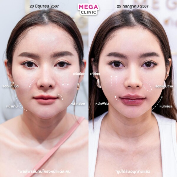 รีวิว Ultraformer ยกกระชับหน้า เมกะคลินิก