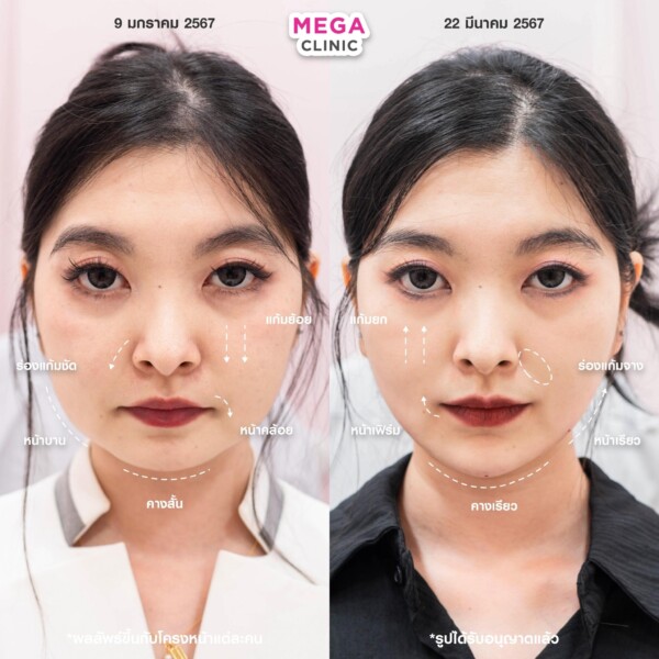 รีวิว Ultraformer ยกกระชับหน้า เมกะคลินิก