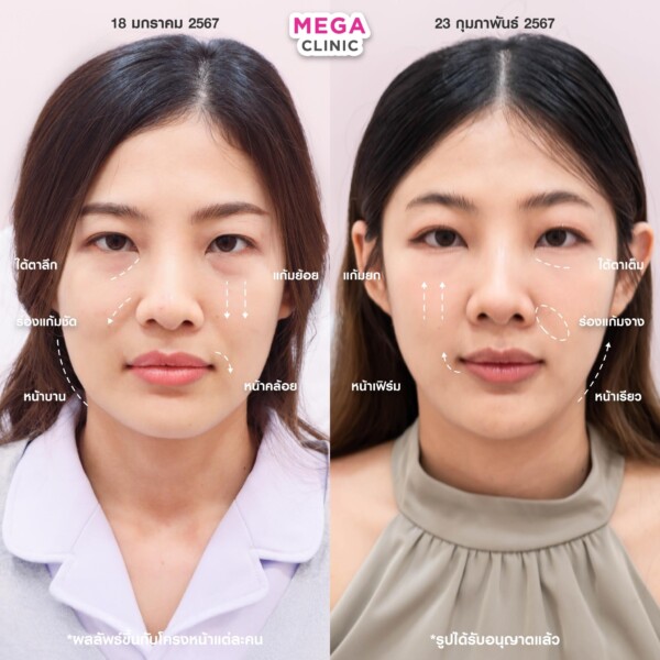 รีวิว Ultraformer ยกกระชับหน้า เมกะคลินิก