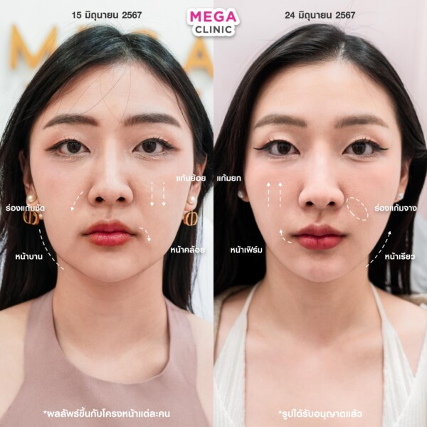 รีวิว Ultraformer ยกกระชับหน้า เมกะคลินิก