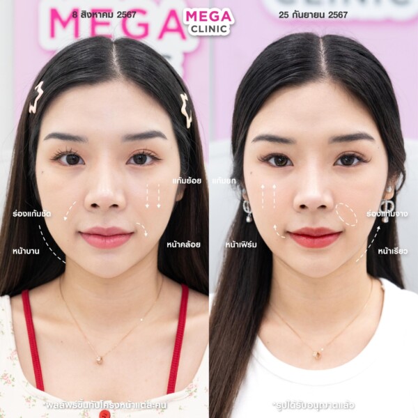 รีวิว Ultraformer ยกกระชับหน้า เมกะคลินิก
