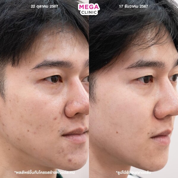 Review Aurawhite ลบรอยสิว 2