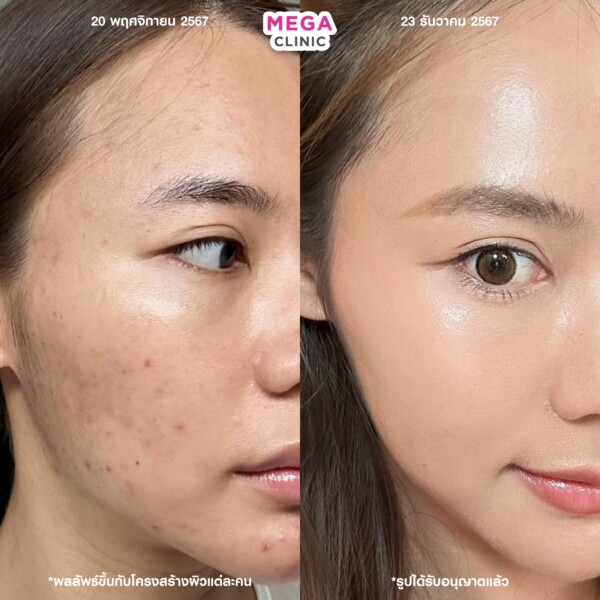 评论 Aurawhite 祛痘印 3