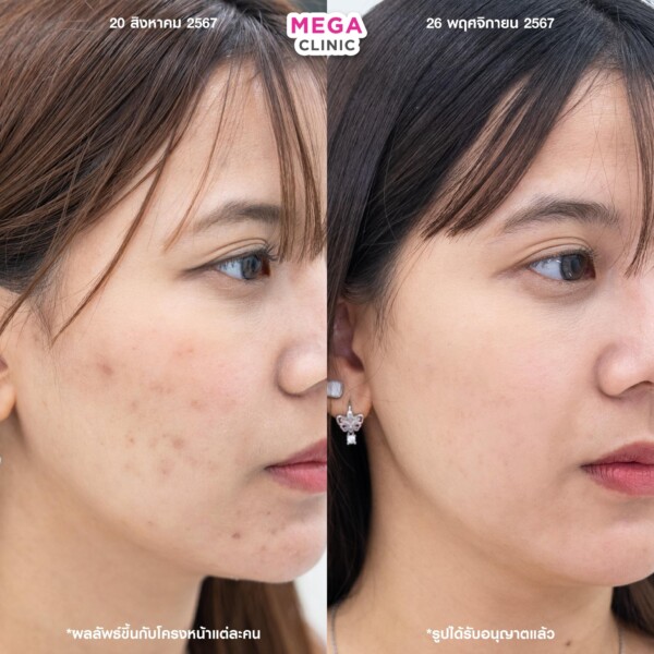 评论 Aurawhite 去除痤疮疤痕 4