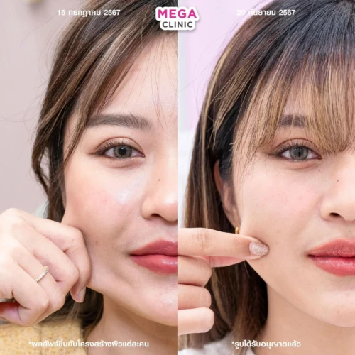 ฉีด sculptra รีวิว