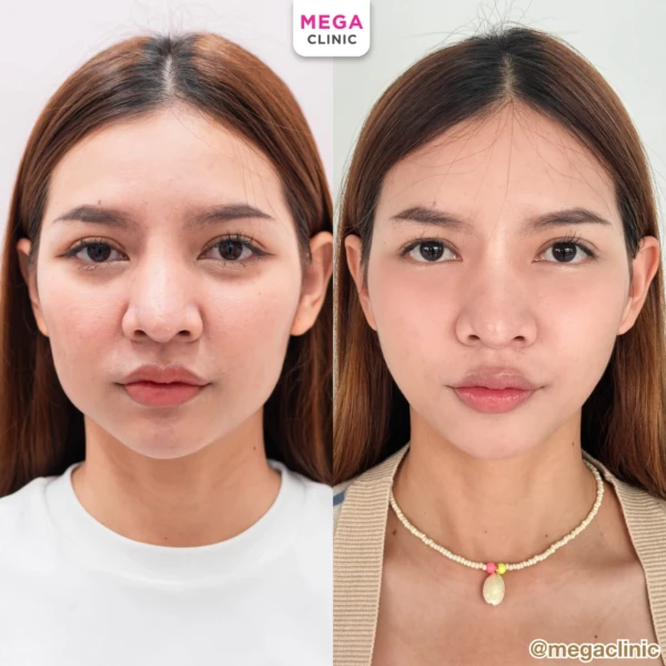 ฉีด sculptra รีวิว