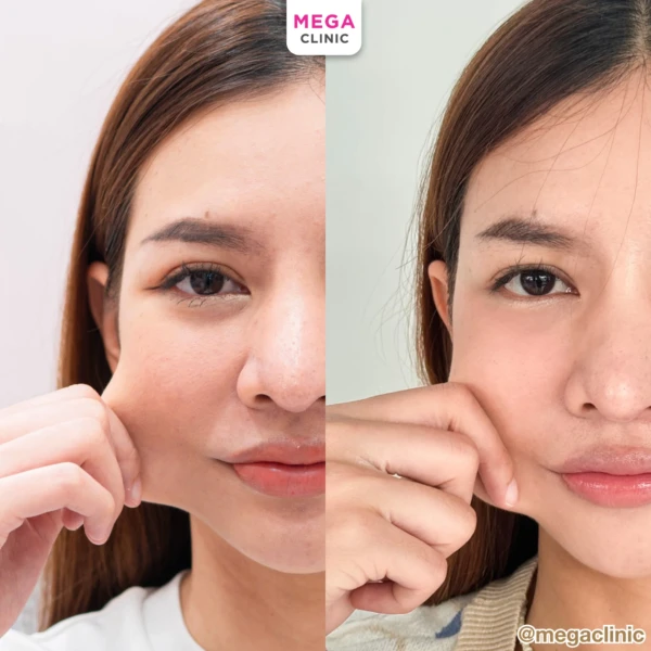 ฉีด sculptra รีวิว