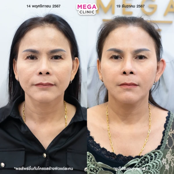 ฉีด sculptra รีวิว