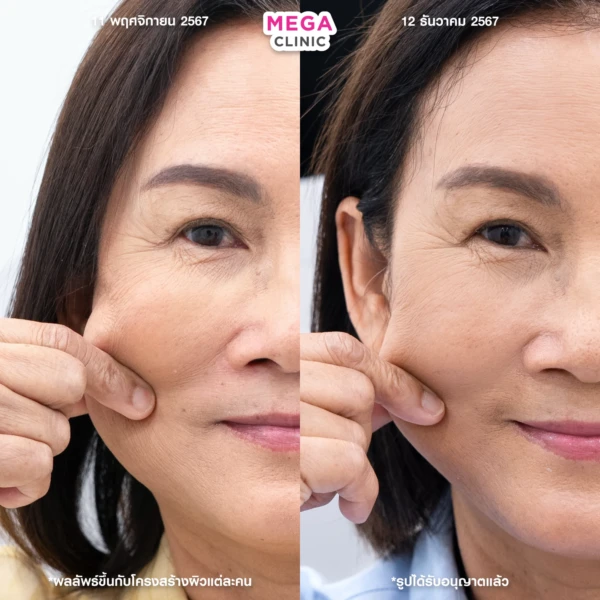 ฉีด sculptra รีวิว