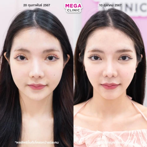 รีวิว ก่อน–หลัง ฉีดแฟตแก้ม ฉีดแฟตเหนียง