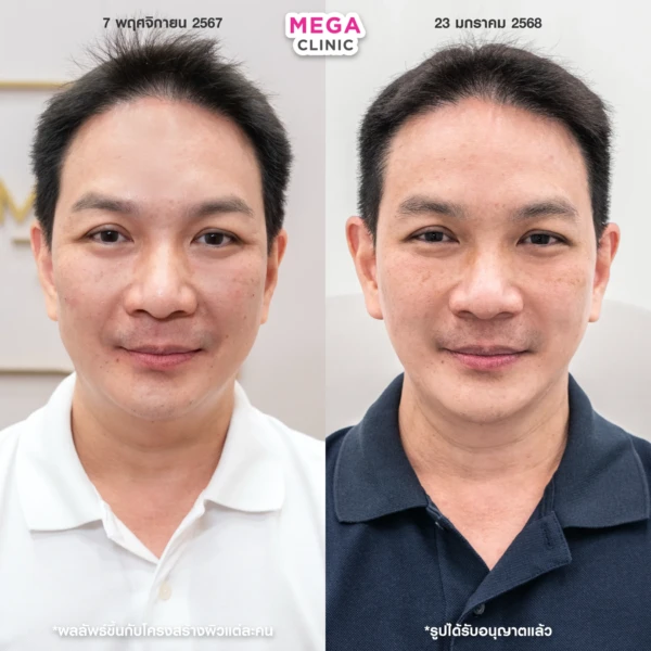 ฉีด sculptra รีวิว