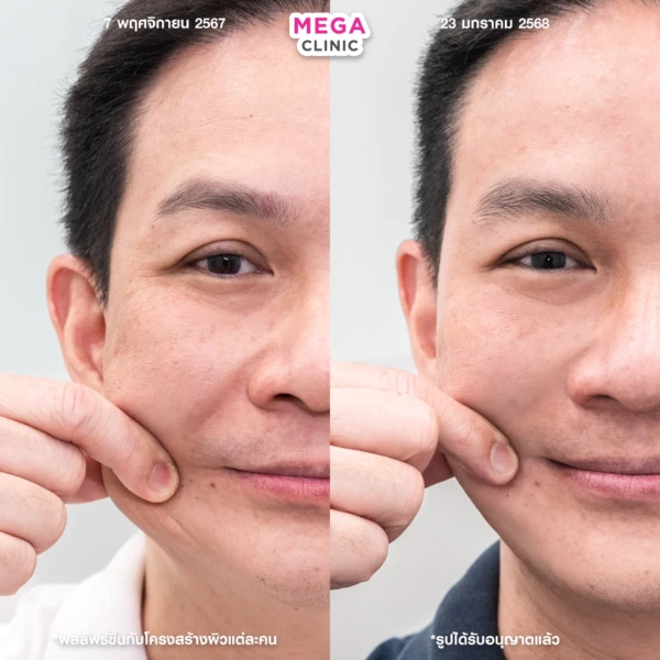 ฉีด sculptra รีวิว