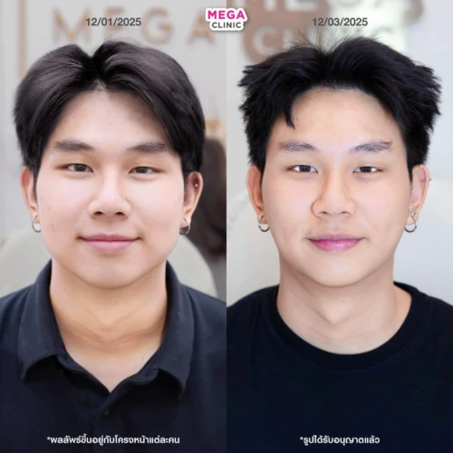 Review: Before & After Fat-Dissolving Injections for Cheeks and Double Chin