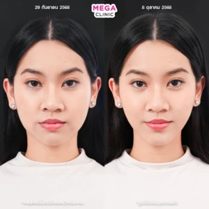 รีวิว ultraformer และ oligio