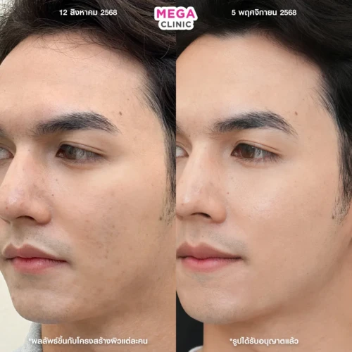 รีวิวฉีด aura white