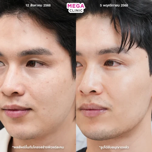 รีวิวฉีดหน้าใส