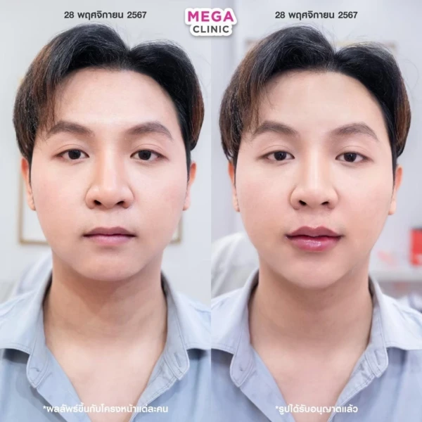 รีวิว ฟิลเลอร์คาง