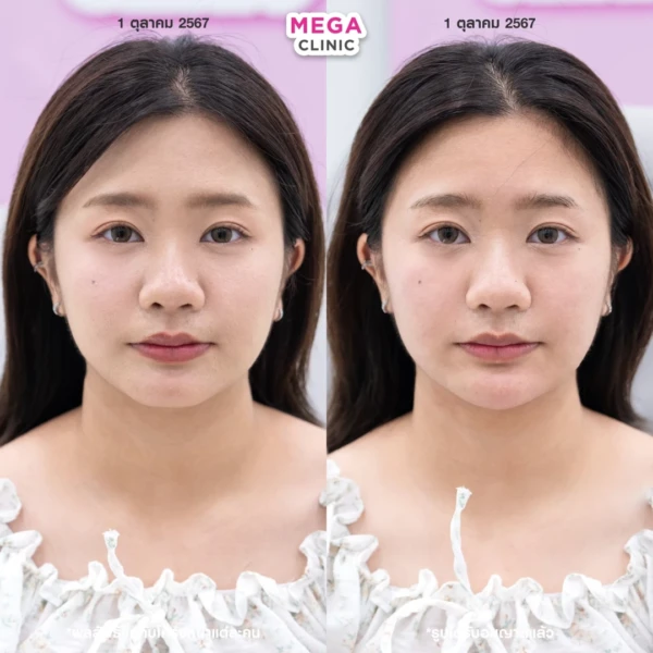 รีวิว ฟิลเลอร์คาง