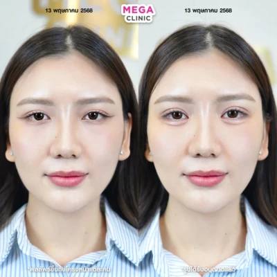 ก่อน-หลังฉีดดอลลี่อาย