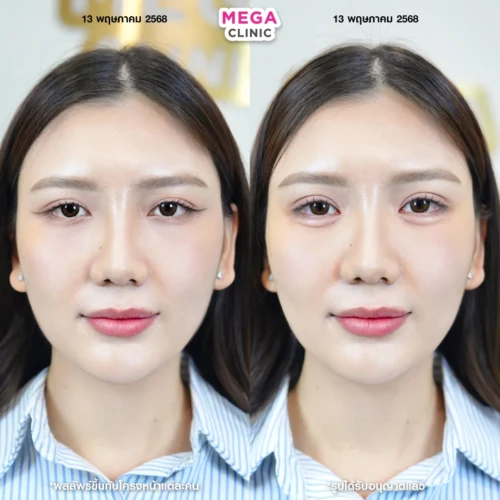 ก่อน-หลังฉีดดอลลี่อาย