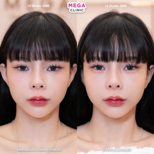 ก่อน-หลังฉีดดอลลี่อาย