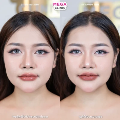 ก่อน-หลังฉีดดอลลี่อาย