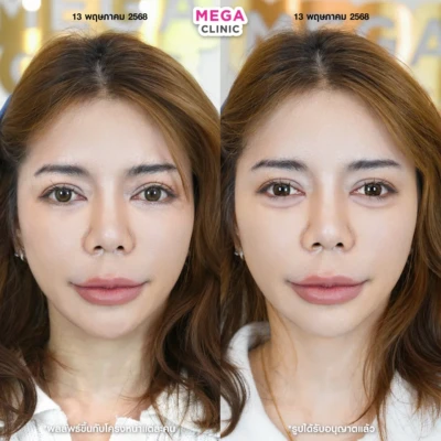 ก่อน-หลังฉีดดอลลี่อาย