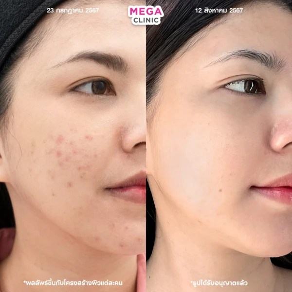 belotero revive รีวิว