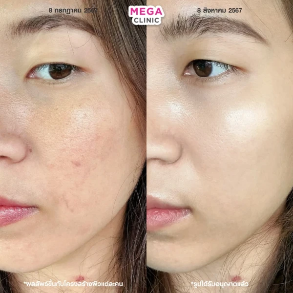 belotero revive รีวิว