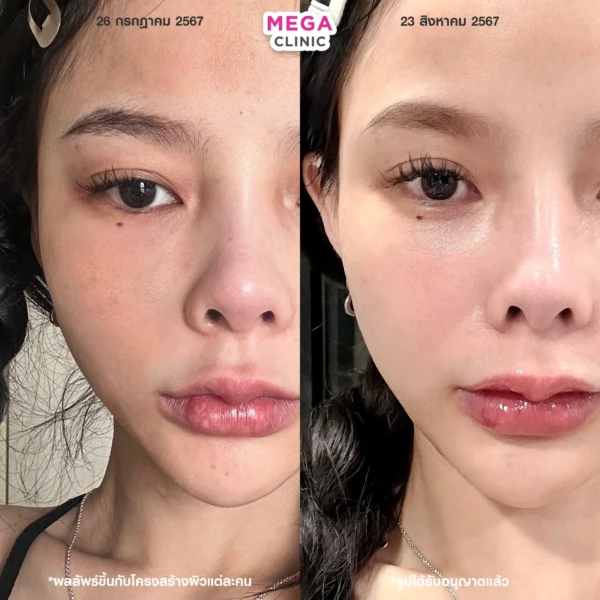 belotero revive รีวิว