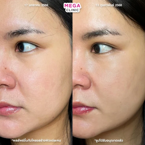 belotero revive รีวิว