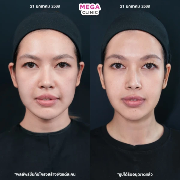 รีวิว ฉีด HArmonyCa เมกะคลินิก 1