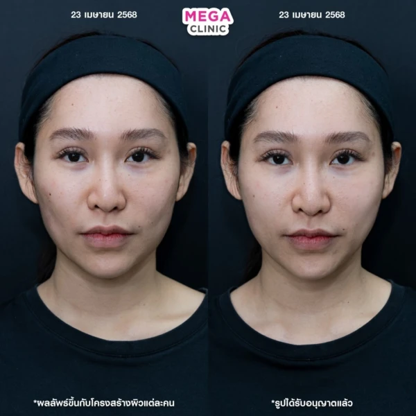 รีวิว ฉีด HArmonyCa คลินิกฉีดหน้า กทม 6