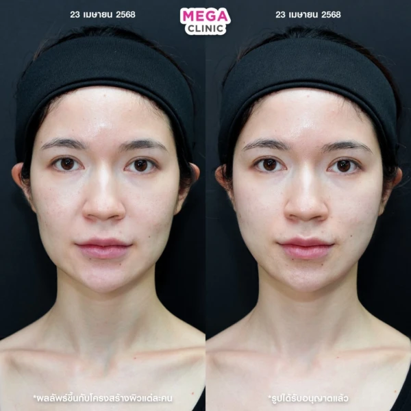 รีวิว ฉีด HArmonyCa คลินิกฉีดหน้า กทม 7