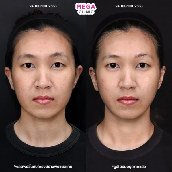 รีวิว ฉีด HArmonyCa คลินิกฉีดหน้า กทม 9