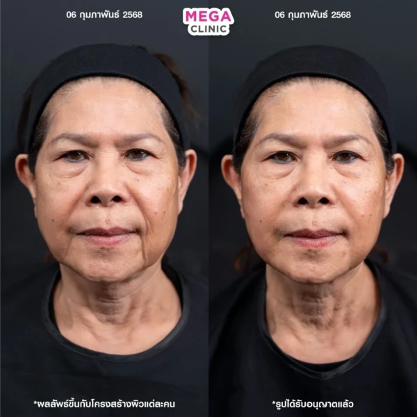 รีวิว ฉีด HArmonyCa คลินิกฉีดหน้า กทม