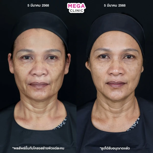 รีวิว ฉีด HArmonyCa คลินิกฉีดหน้า กทม 1