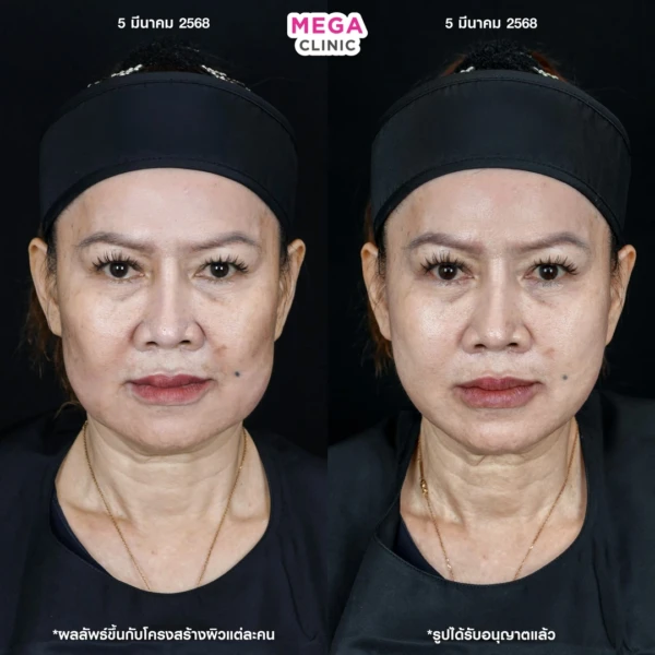 รีวิว ฉีด HArmonyCa คลินิกฉีดหน้า กทม 2