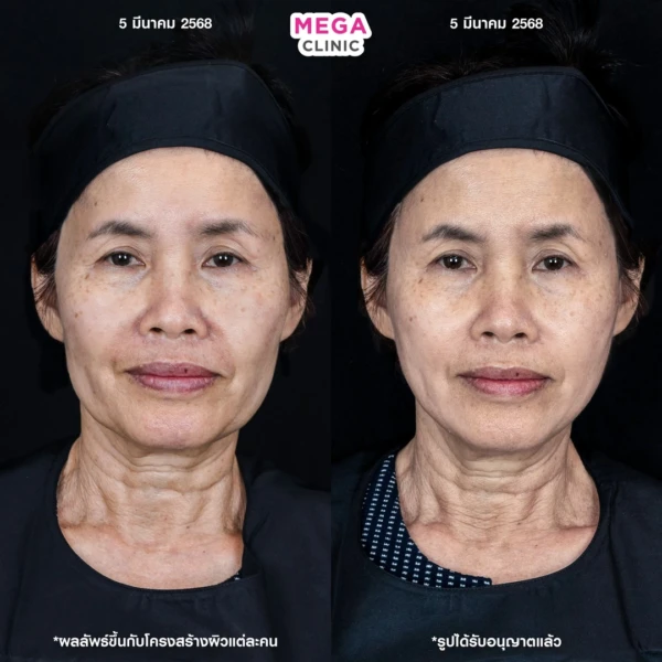 รีวิว ฉีด HArmonyCa คลินิกฉีดหน้า กทม 3