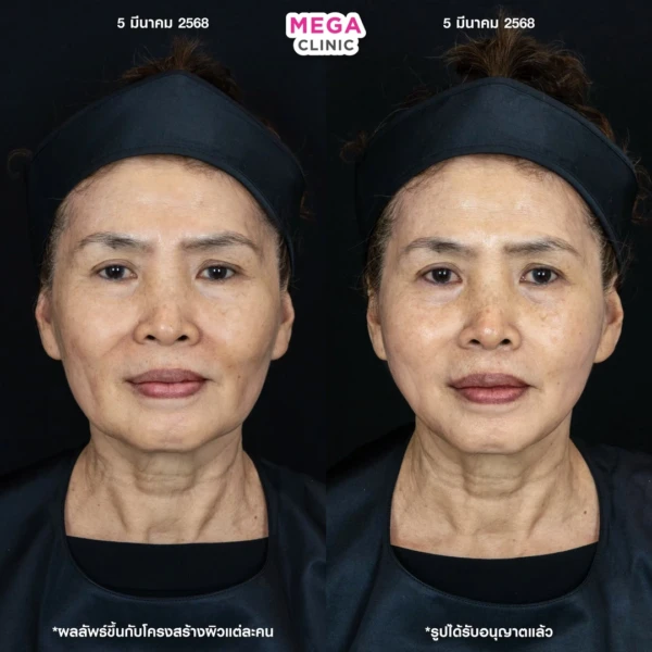 รีวิว ฉีด HArmonyCa คลินิกฉีดหน้า กทม 4