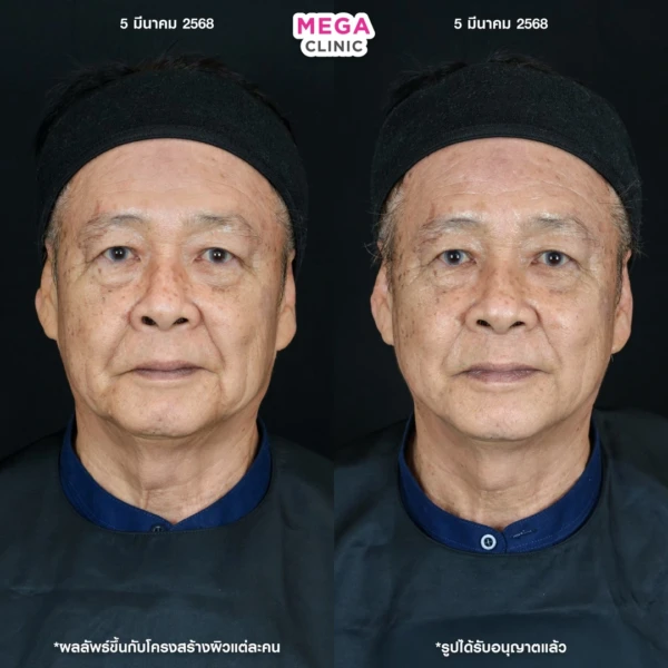 รีวิว ฉีด HArmonyCa คลินิกฉีดหน้า กทม 5