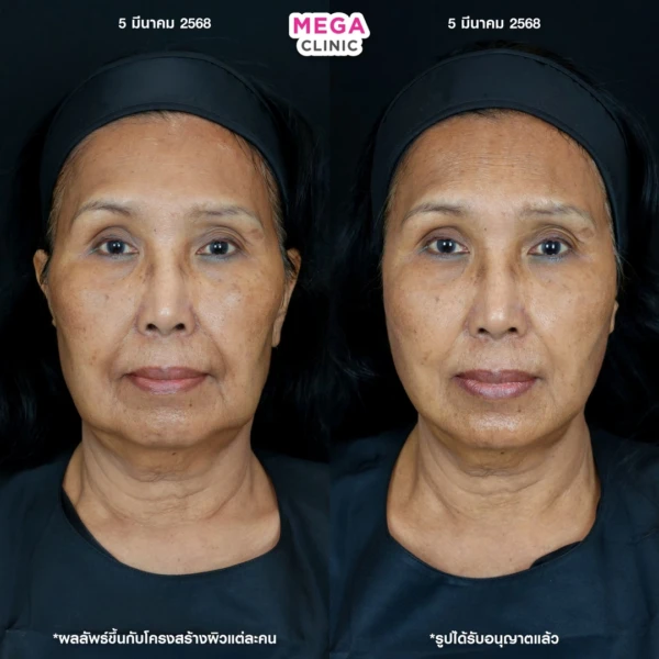 รีวิว ฉีด HArmonyCa คลินิกฉีดหน้า กทม 6