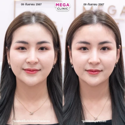 ฟิลเลอร์ขมับ รีวิว ฟิลเลอร์ขมับ รีวิว