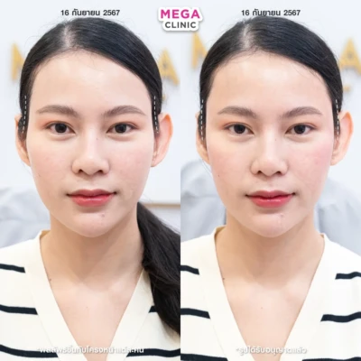 ฟิลเลอร์ขมับ รีวิว