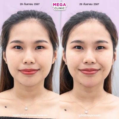 ฟิลเลอร์ขมับ รีวิว ฟิลเลอร์ขมับ รีวิว