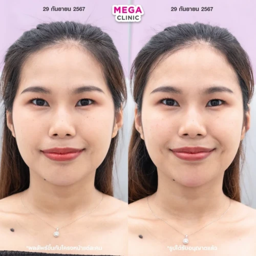 ฟิลเลอร์ขมับ รีวิว