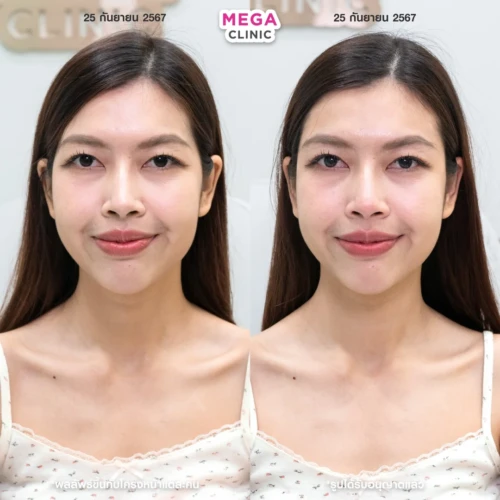 ฟิลเลอร์ขมับ รีวิว